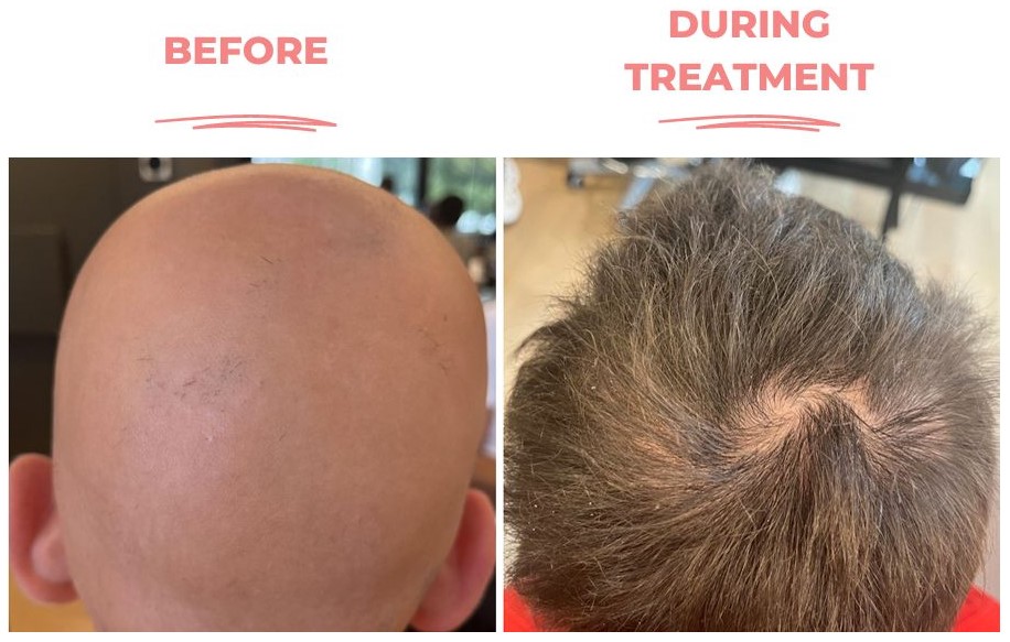 Baricitinib for Alopecia: Can This Arthritis Drug Really Regrow Hair?