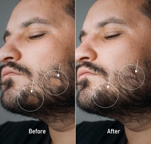 Beard and Minoxidil
