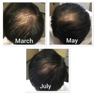 hair loss dermatologist near me